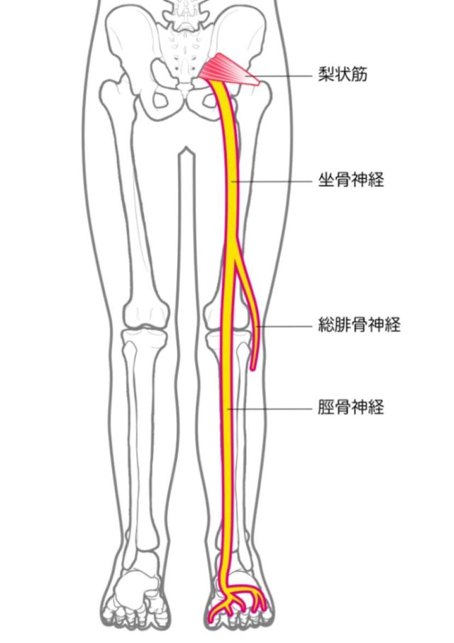 坐骨神経痛の症状で痛みの発生する箇所